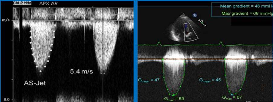 原创孔令秋超声心动图十大基本功72主动脉瓣狭窄的超声心动图定量