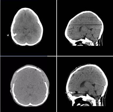 颅脑缝隙过早关闭会有那些危害呢?听听专家讲解吧