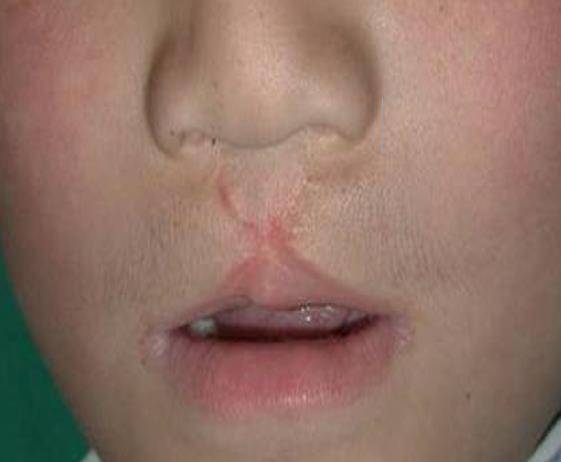 兔唇案例讲解五:双侧唇裂修复后唇鼻畸形问题及修复方法