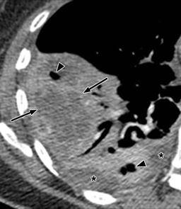 肺部感染可能出现的ct征象,你见过几个?(上)_支气管