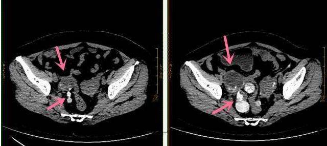 原创卵巢癌:一个癌症康复患者的心里话