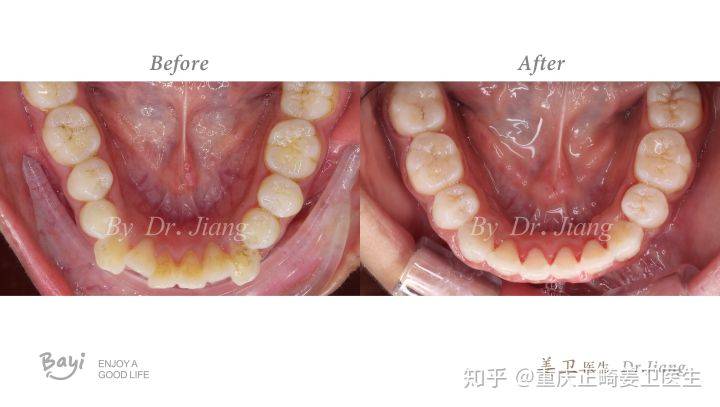 重慶牙齒矯正(正畸)【案例】—下頜發育不足 牙列不齊 前牙開合