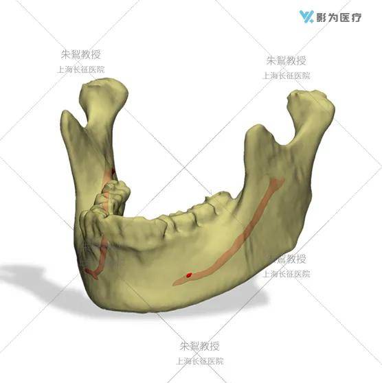 下颌骨三维图图片