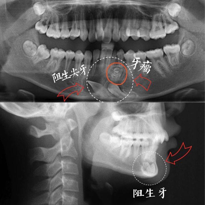 重慶牙齒矯正正畸案例先天性缺牙牙列不齊深覆合