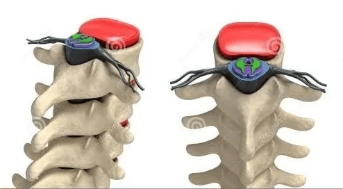 颈椎不仅支撑头的重量,还有很大的活动范围.