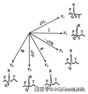 cabrera心電圖導聯排列方式