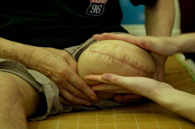 24针的伤疤像一条巨大的蜈蚣,盘在父亲残肢上,啃噬着王国平的心,"又麻