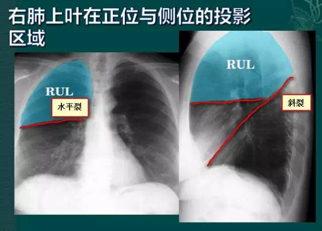 拿到胸片却不会看?送你7个窍门,手把手教你解读胸片