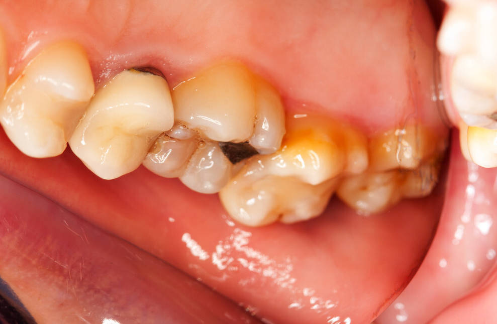 夜晚经常磨牙真的都是肚子里有"虫"引起吗?