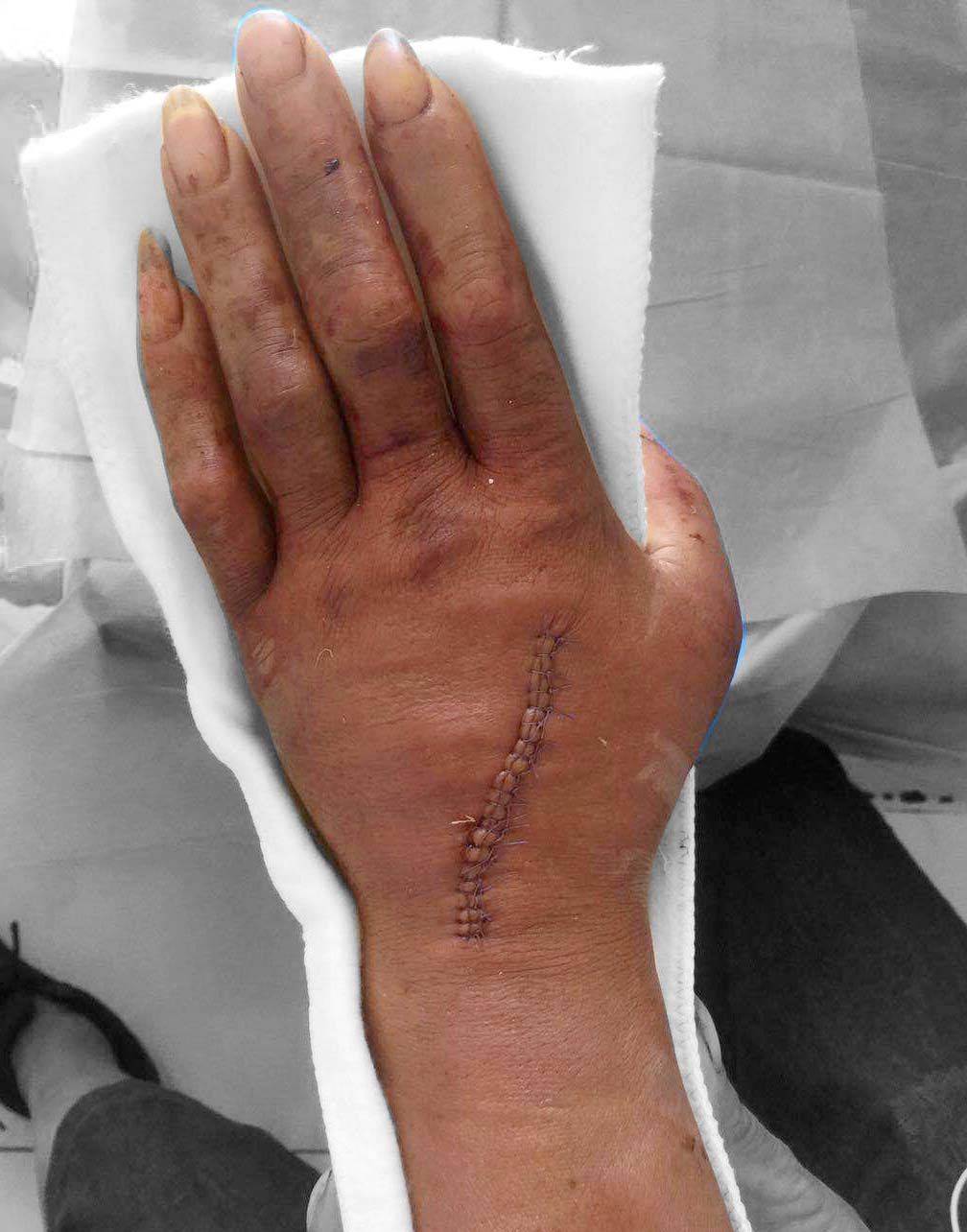 手指肌腱缝合术图片