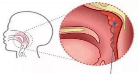 90%家长疑惑:孩子增殖体肥大,能不能全麻手术?