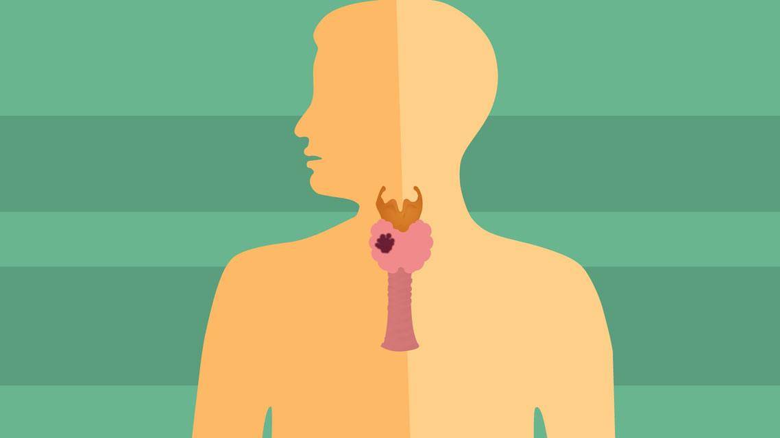 北京崇文门中医院翟章锁主任一心为民,根据四十年临床经验总结甲亢饮