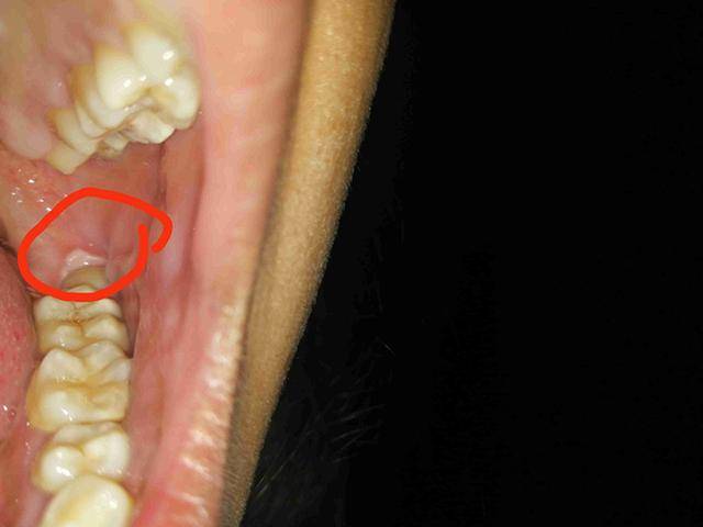 怀孕8个月孕妈智齿发炎脸肿到说不出话智齿需不需要提前拔