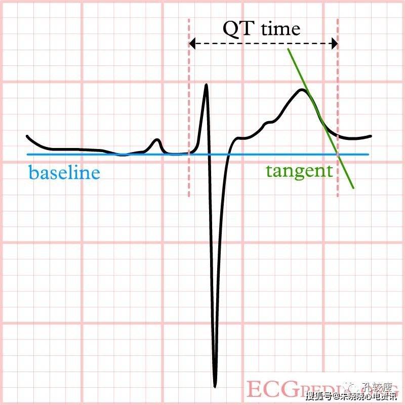 心电图机自动分析的结果是准确的,但如有早搏等心律不