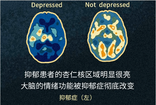 重度抑郁症大脑图片