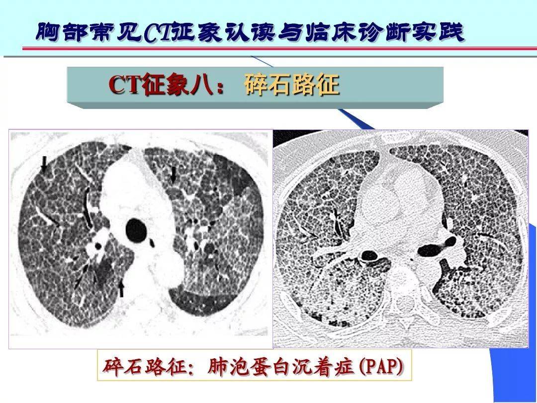体检后拿到肺部c却不会看用ct实图教你分辨10大常见征象二