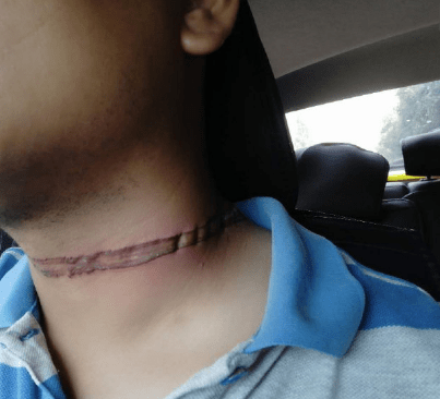 西安男子骑电动车被悬空电线勒伤脖子,至今无人出面沟通赔偿事宜