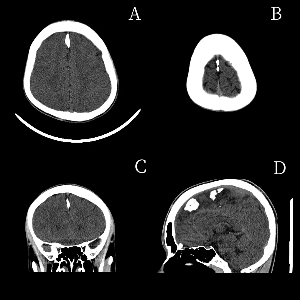 但通过观察侧脑室三角区钙化的脉络丛有无移位及根据移位的方向对脑内