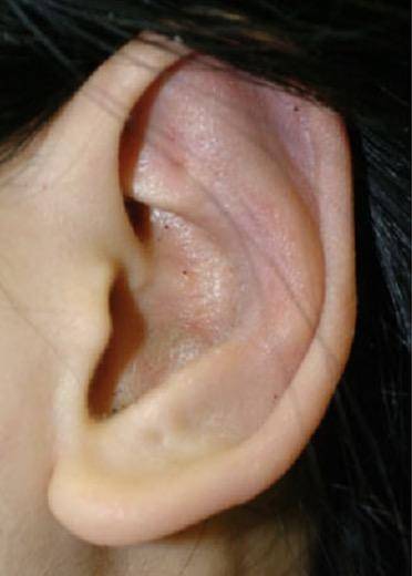 招风耳怎么治疗?_耳甲