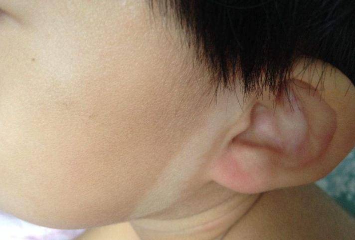 宝宝脸上的"胎记",都是孕期宝妈的"不小心",最好避免下