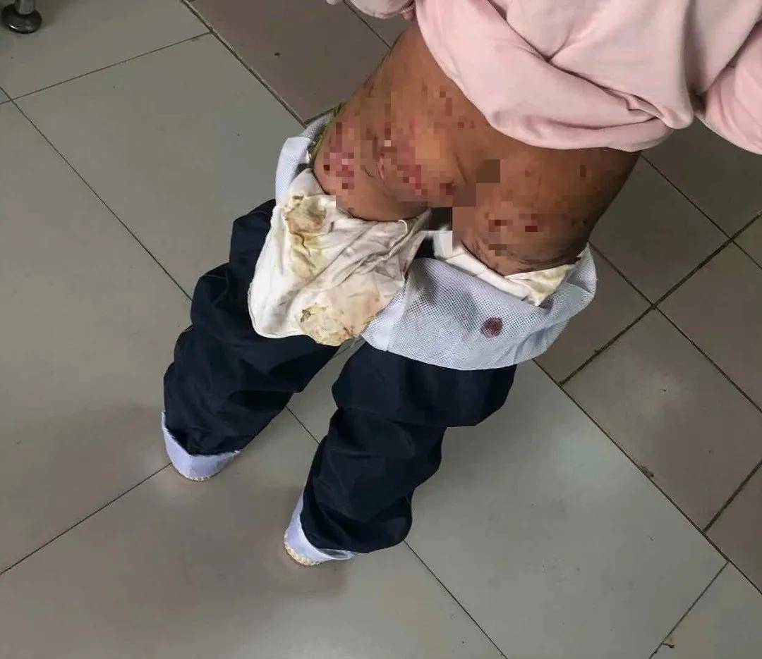 伤口用烫红的火钳夹烫用绳子鞭打▼一个小女孩长期遭受亲生母亲的家暴