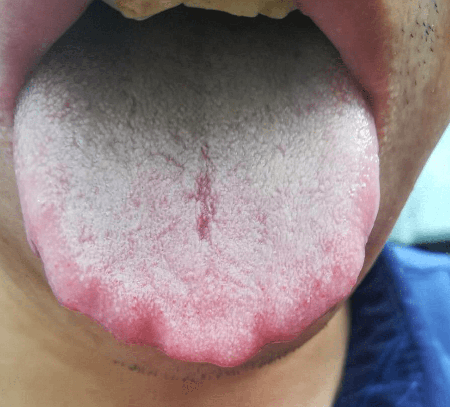 脾虚舌头的症状有图片图片