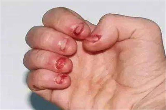 啃指甲吃手指孩子这些小动作暗藏风险儿科医生这是一种病