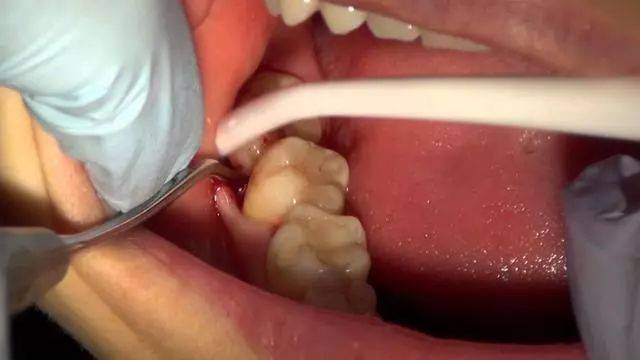 市北百德医院温馨提示为什么要拔智齿看完你就明白了