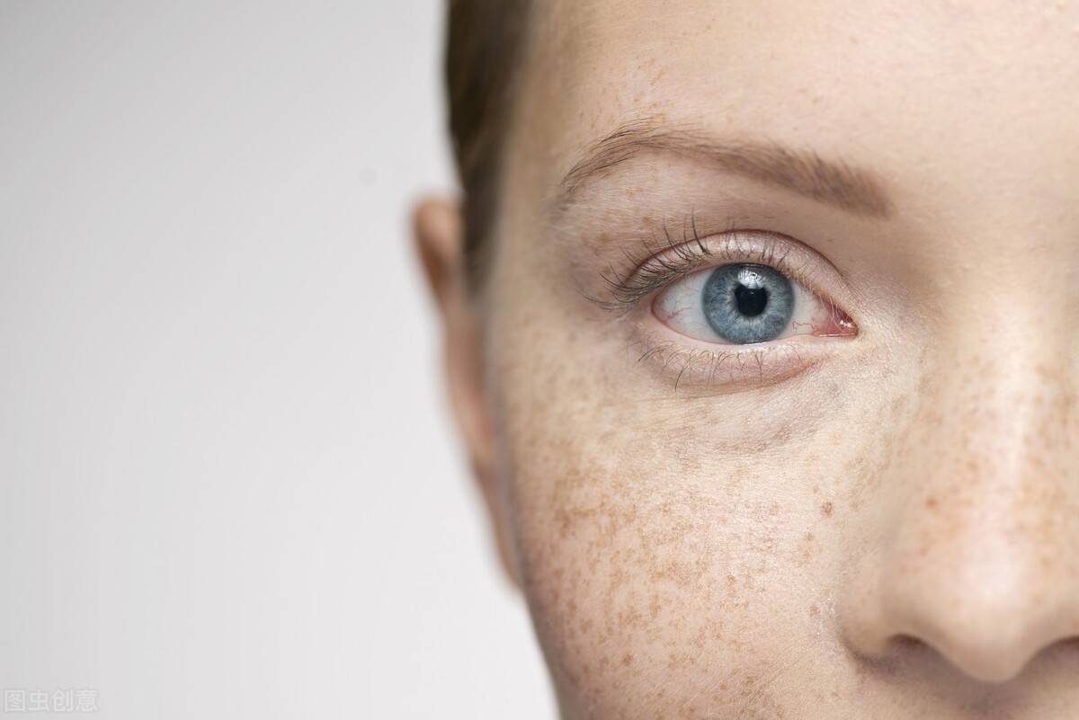 科普:脸上斑点常见有4种你是哪种?预防长斑是关键