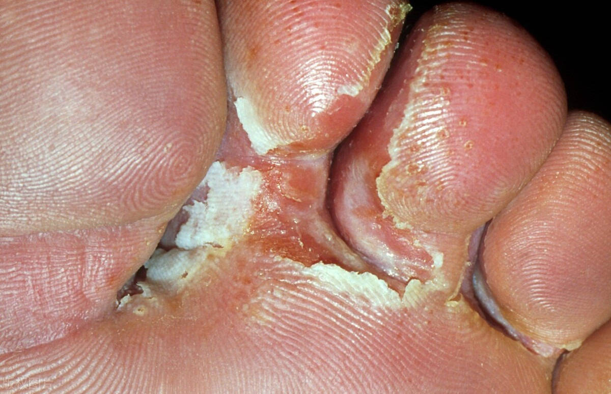 原创香港脚老是不好,或者老是复发,怎么办?还是要从体质来调理