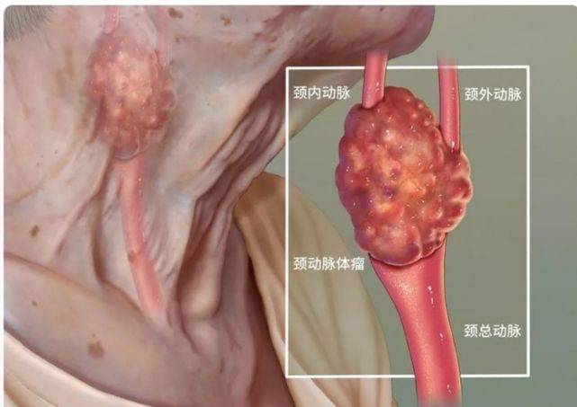 西安大兴医院脑科医院团队:精准拆弹—罕见巨大颈动脉体瘤