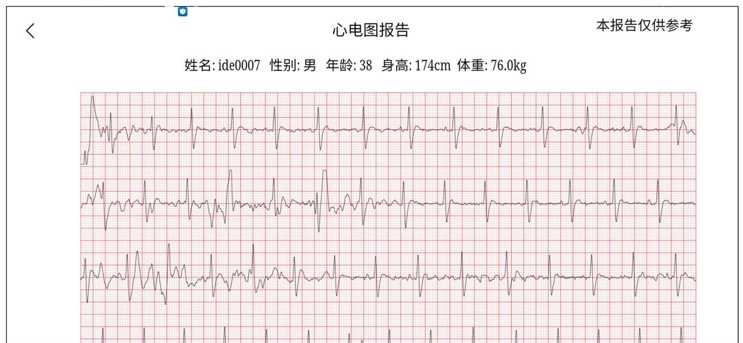 踏车心电图图片