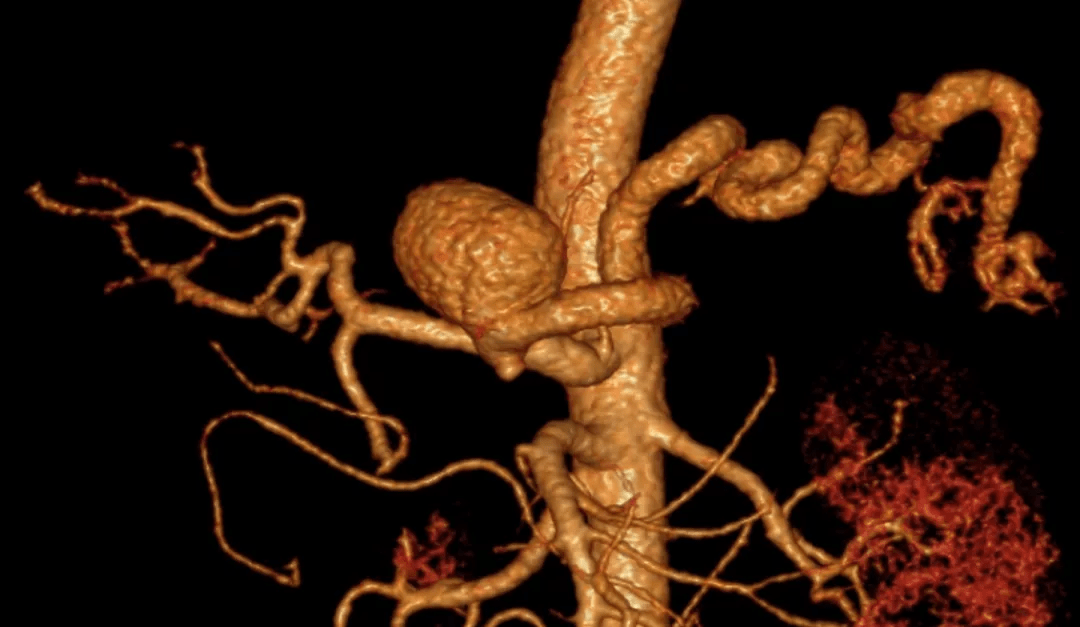 吃坏肚子意外发现动脉瘤还好赶在未破裂前处理掉