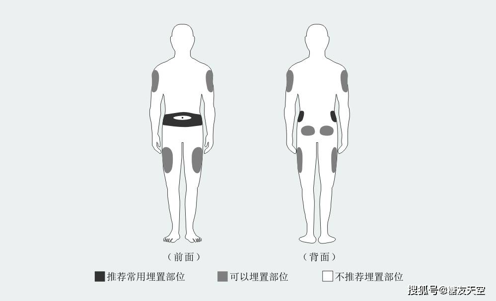 大腿外側,後腰,臀部等,需避開腹中線,瘢痕,胰島素注射硬結,腰帶位置