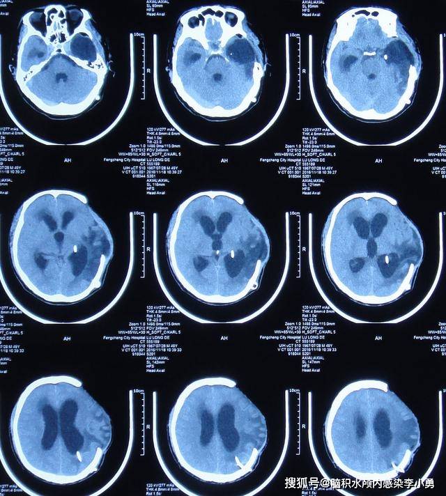 车祸脑外伤脑积水性脑膨出外院7个月内4次住院治疗后脑积水脑膨出无