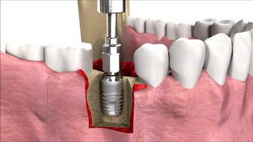 種植牙是怎麼種植的過程流程有哪些步驟