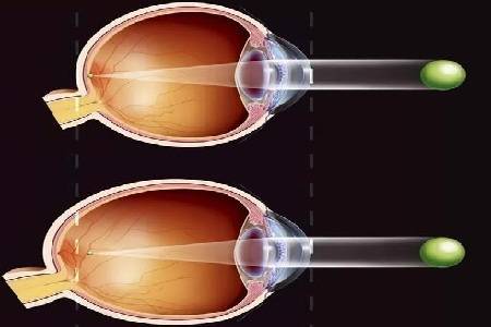 首大熊瑛屈光参差是什么原因造成的有哪些危害