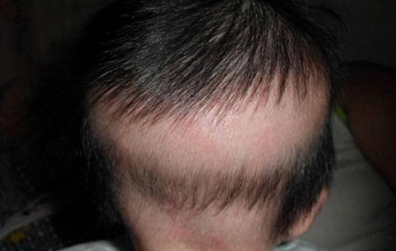 为啥宝宝后脑勺的头发越来越少