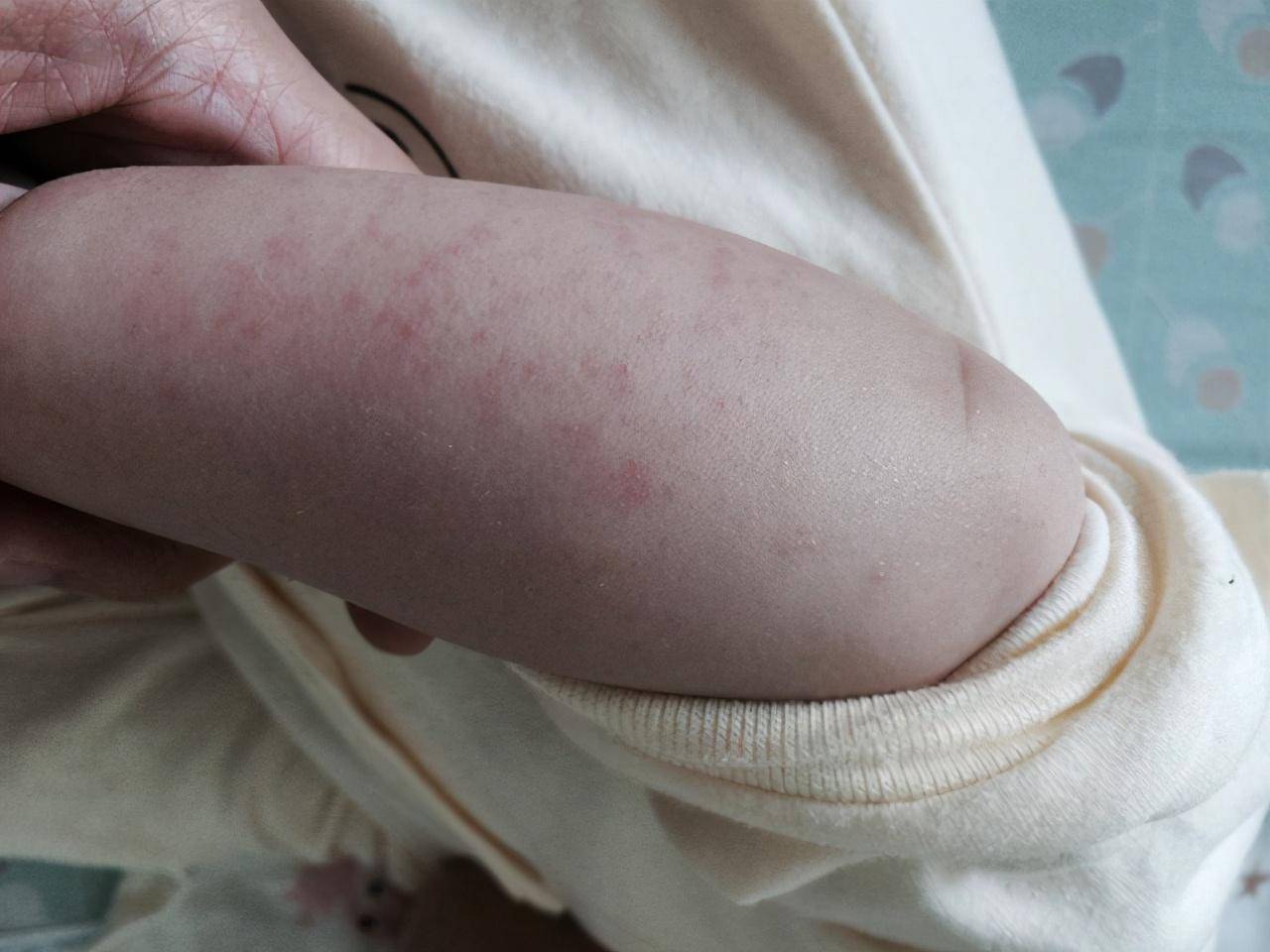 的食物不是母乳就是奶粉,所以牛奶蛋白可能是宝宝最早接触到的过敏原