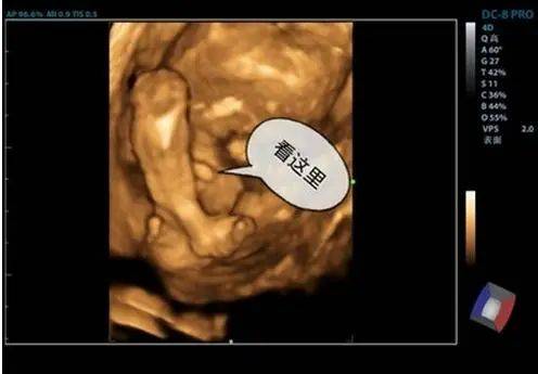 17周胎儿性别图图片