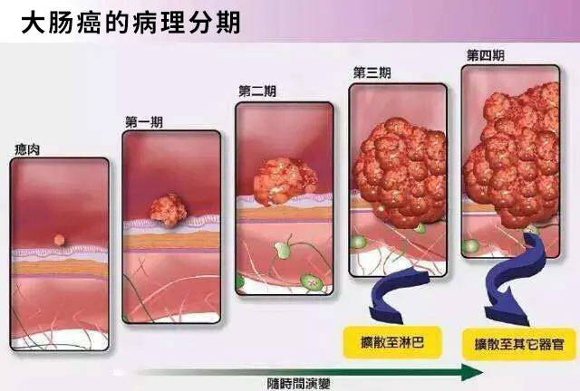 直肠癌在初期往往会被误诊为痔疮如何辨别