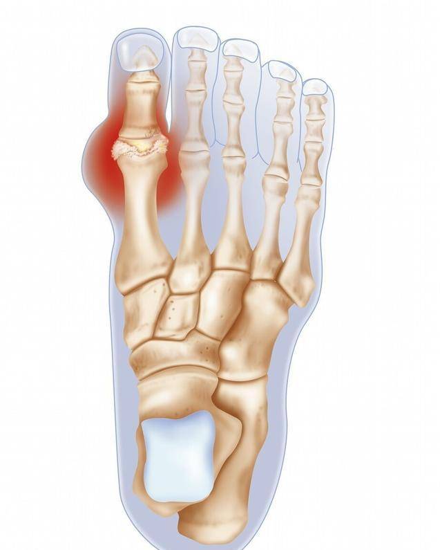 痛风为啥总盯着你的脚趾头远离痛风的秘诀看这里