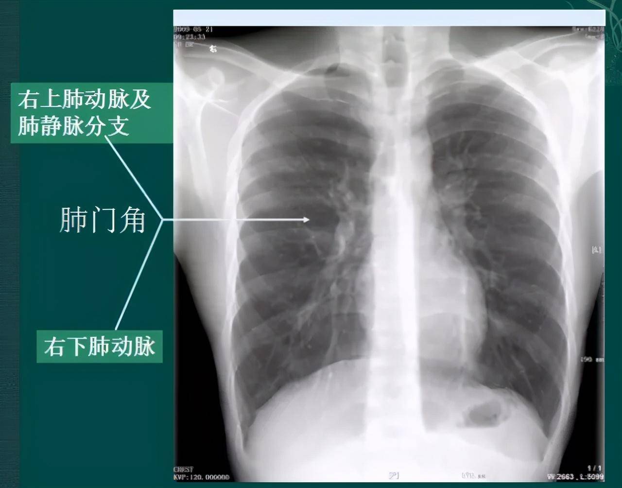 胸片入門攻略,看完不信你還學不會!