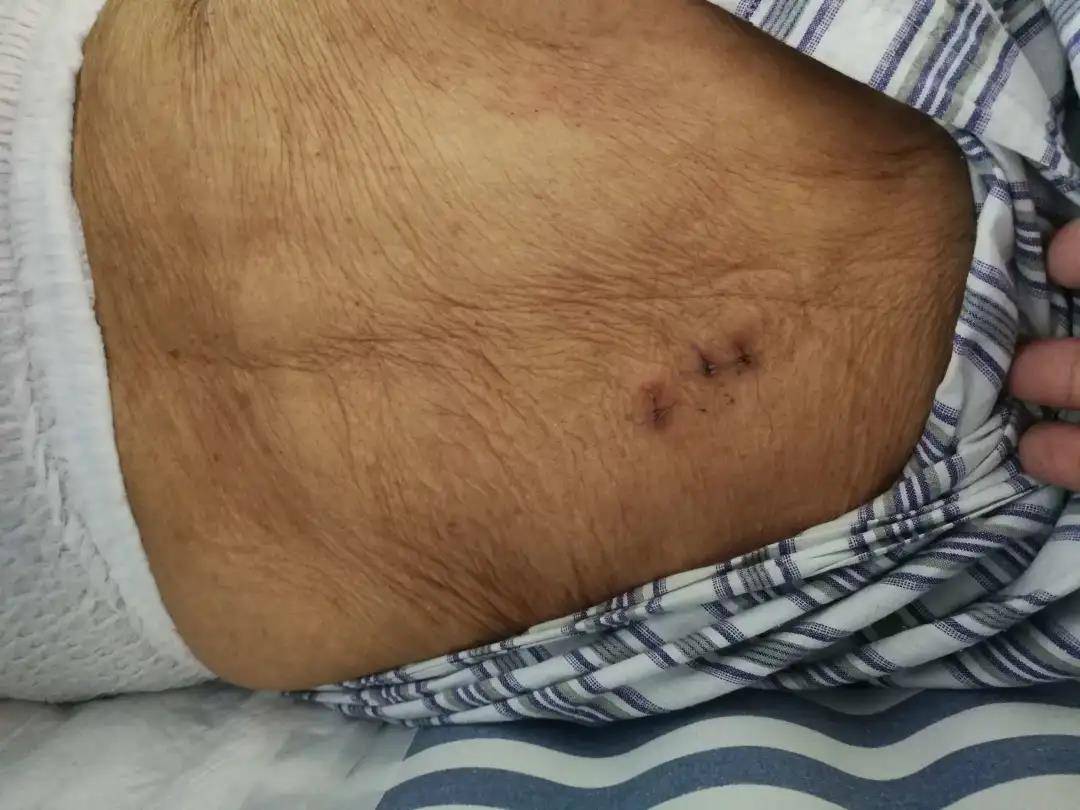 治疗|杭州城东医院案例丨90岁高龄椎体压缩性骨折新技术—?经皮穿刺椎体后凸成形术