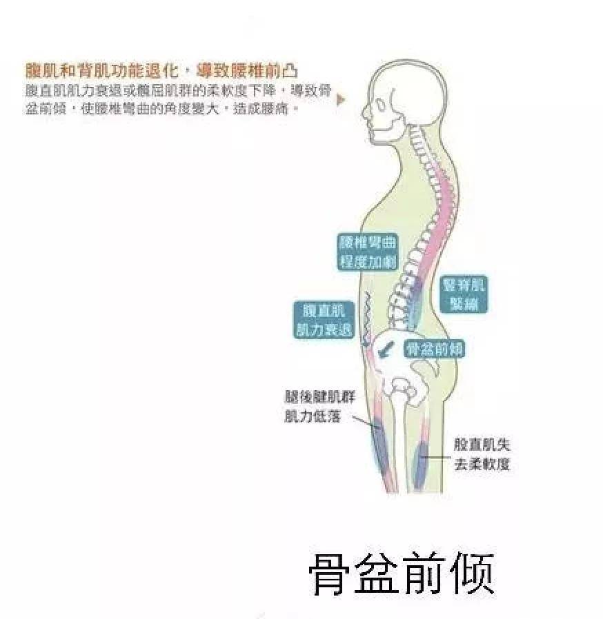 骶骨前傾