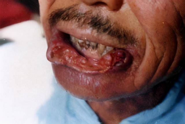 此物伤肾被世卫组织定为一级致癌物却有6亿人在吃