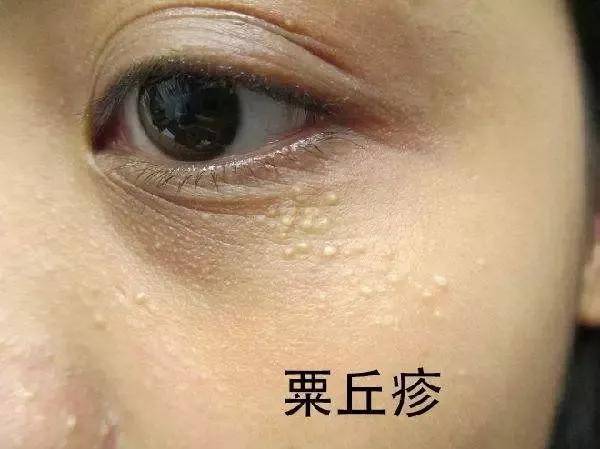 閉口粉刺的10問10答怎麼去除呢