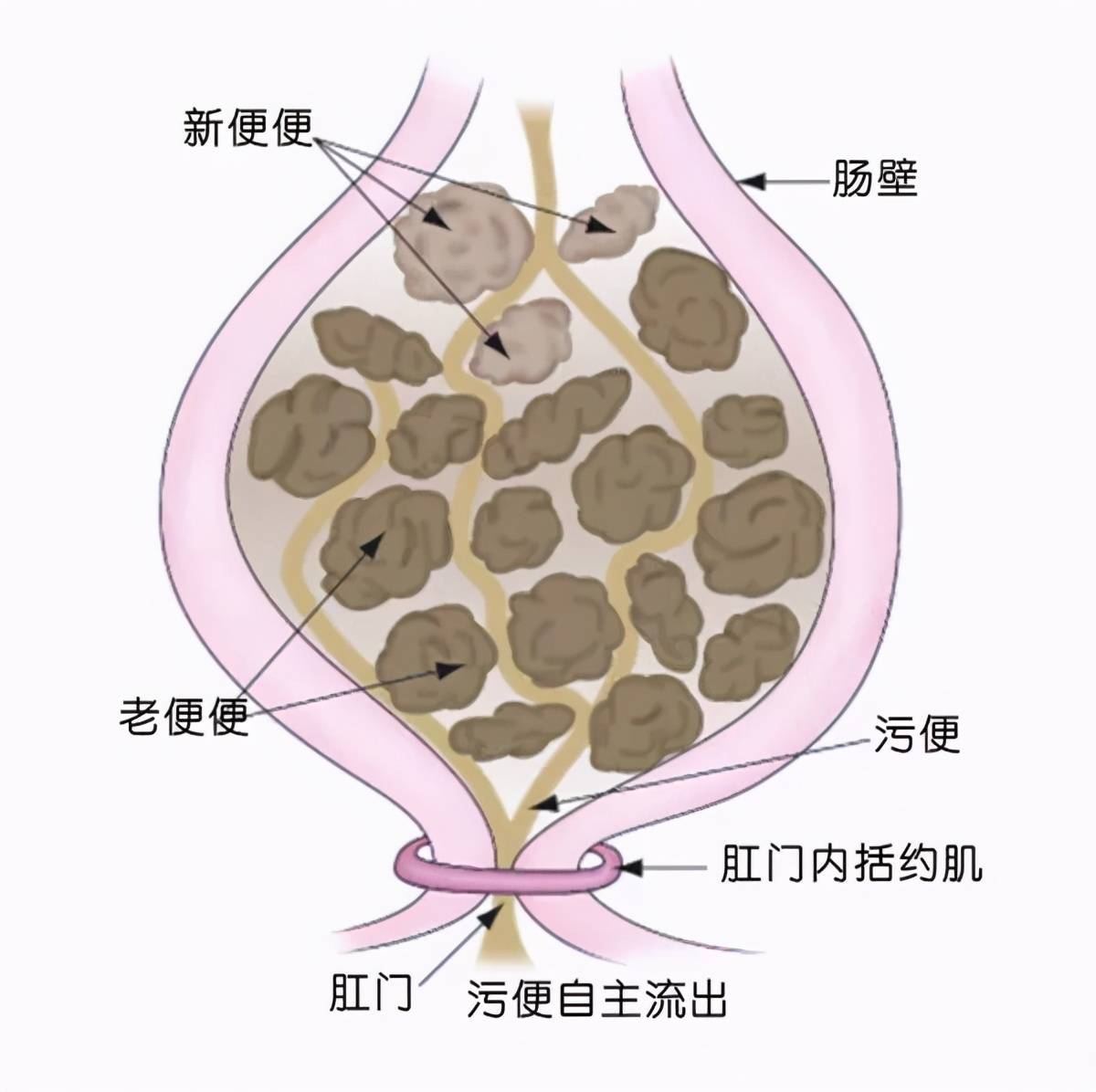 原創都是老年人的難言之隱別把糞便嵌塞當成肛門失禁