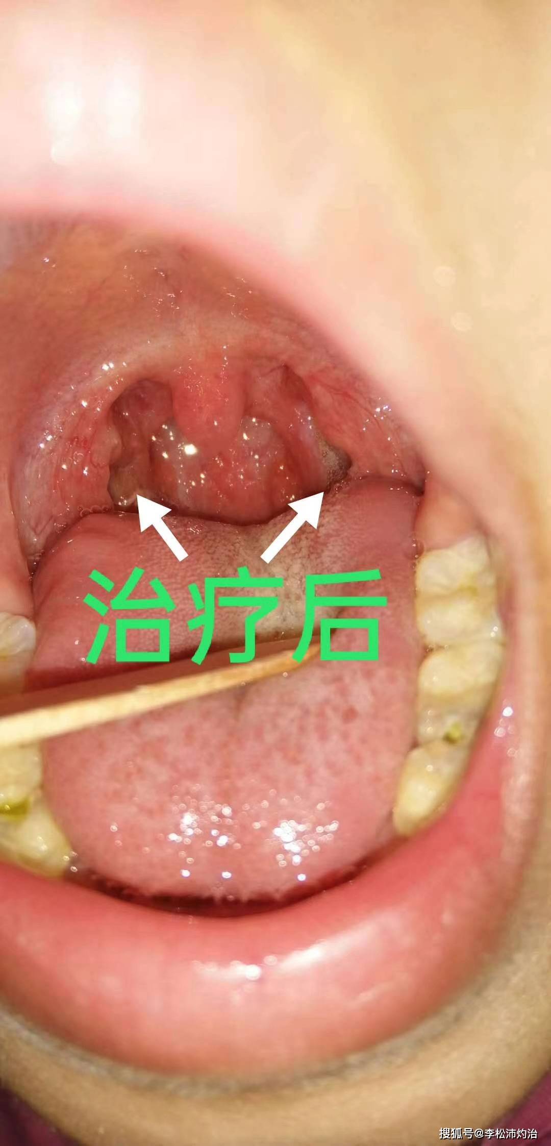 扁桃体灼烙法治疗价格便宜,这种技术是噱头吗?