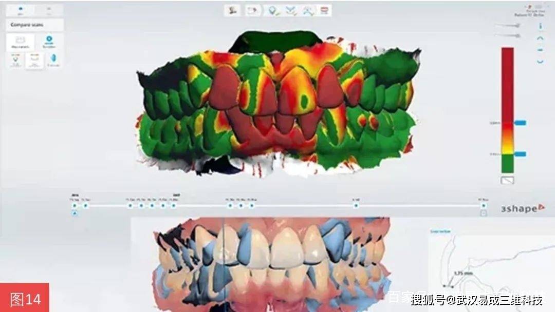 3shape代理分享一站式间接修复的椅旁流程